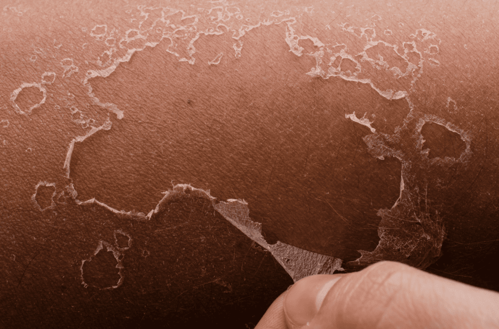 How to Record the Ocean Sounds 6 burnt skin macro skin slides hand tears off